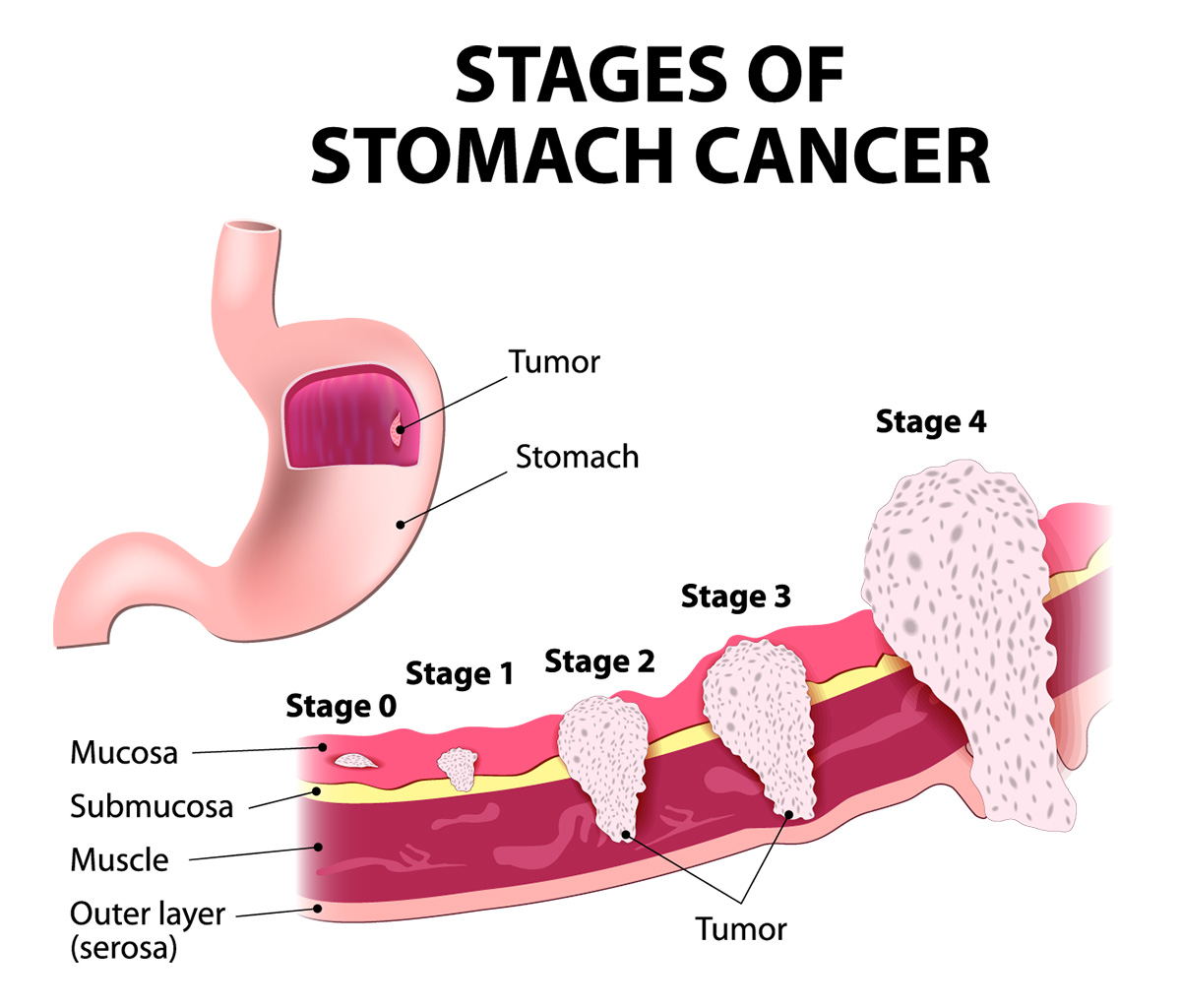 stomuch1