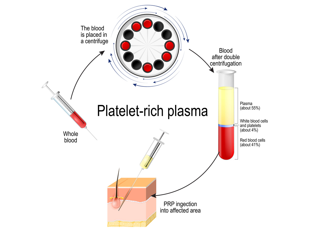 prp process