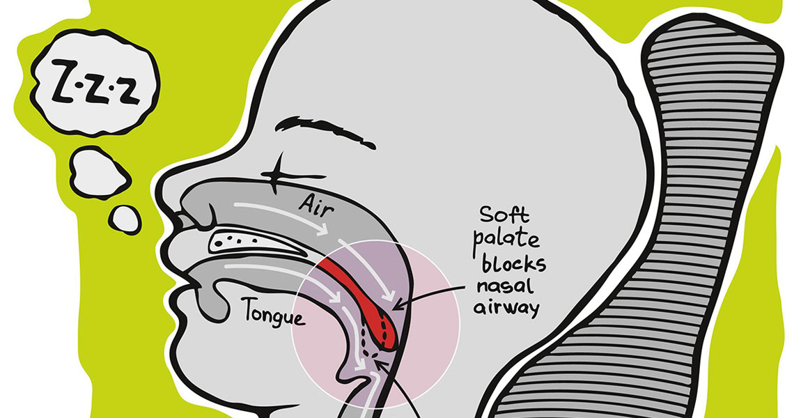 Obstructive Sleep Apnea Syndrome