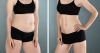ทางเลือกหุ่นดีโดยไม่ต้องควบคุมน้ำหนัก ด้วย &#039;Vaser Liposuction 2.2 Def Hi&#039; มาตรฐานสหรัฐอเมริกา